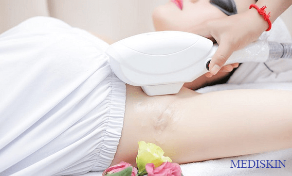 Triệt lông phương pháp IPL