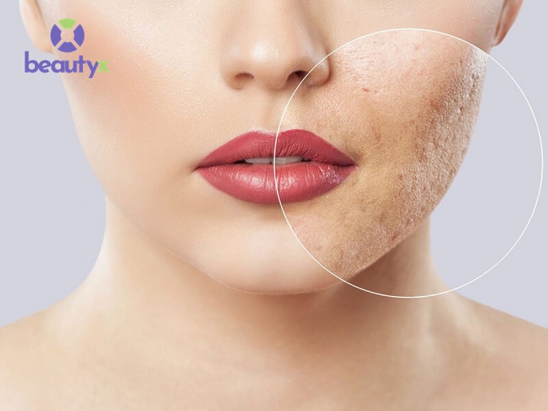 Dịch vụ trị sẹo tại Jena Beauty rất được ưa chuộng