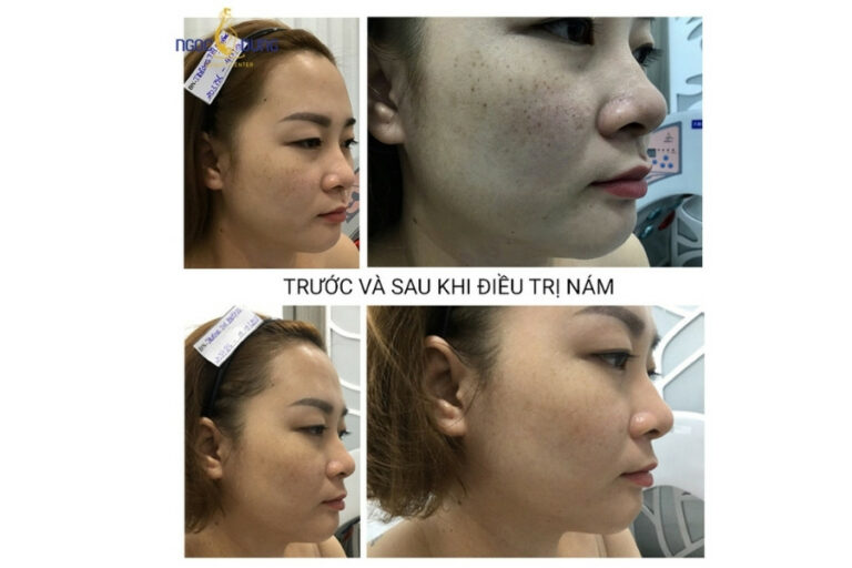 Kết quả điều trị nám bằng laser Toning