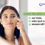 Cách trị nám tại nhà hiệu quả