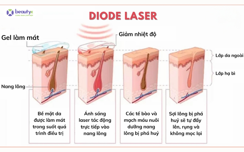 Phương pháp triệt lông Diode Laser rất được ưa chuộng hiện nay