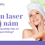 Bắn laser trị nám - Phương pháp này có hiệu quả không?