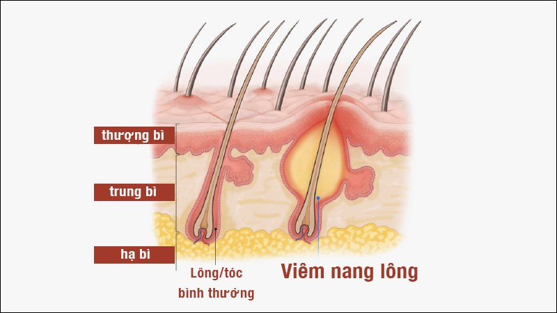 Tình trạng viêm nang lông là gì?